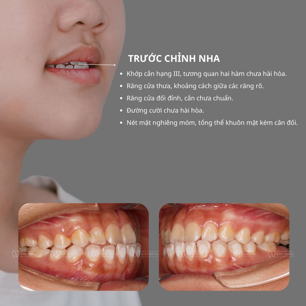 niềng răng bị móm bao nhiêu tiền